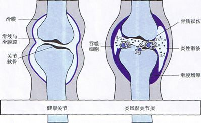 類風濕關節炎檢測 項目更齊全